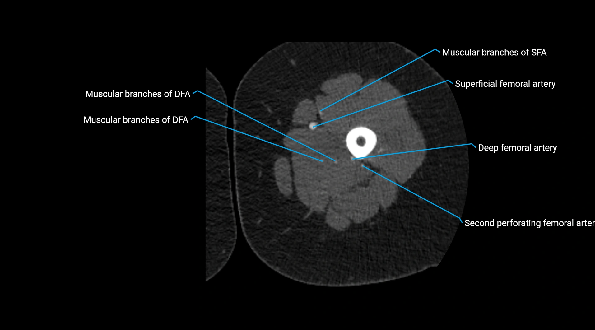 CTA lower limb cross sectional anatomy labelled image _113.webp